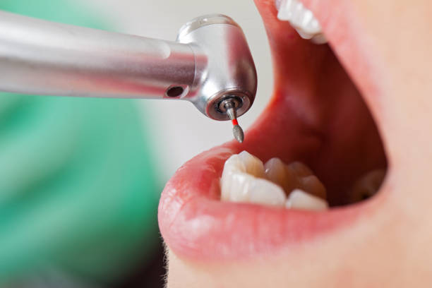 Best Knocked-Out Tooth (Avulsed Tooth) Treatment in Loudonville, NY